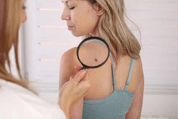 What Are Traditional Skin Lesion Removal Methods Poole?