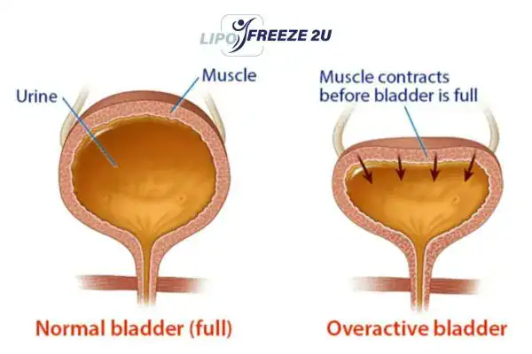diagram of overactive bladder treatment Poole
