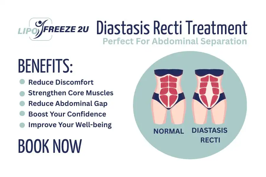 How Long Will It Take to See Improvements in Diastasis Recti Poole