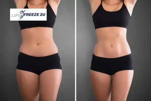 How Can LIPO FREEZE 2U Support Your Post-Pregnancy Body Recovery Poole?