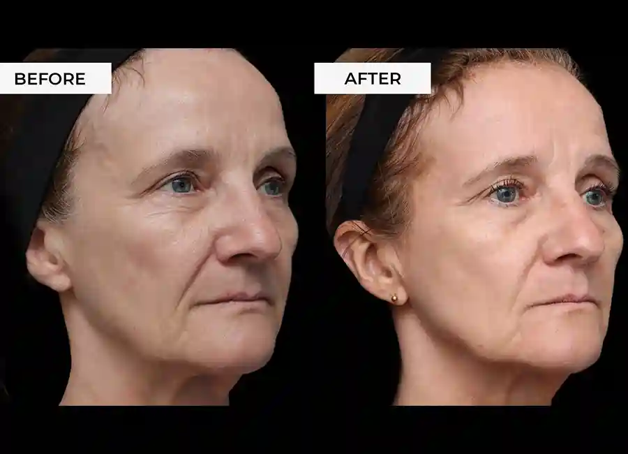 How Many RF Microneedling Sessions Will You Need to See a Difference Poole?