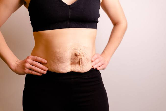 Is Surgery Really the Only Way to Repair Diastasis Recti Poole?