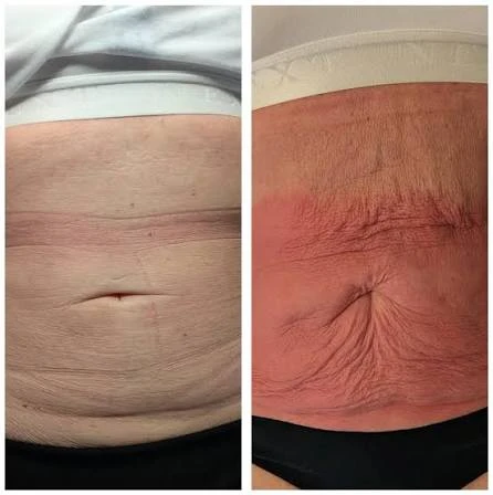 How Does RF Microneedling Improve Crepey, Thin and Uneven Skin Texture Poole?