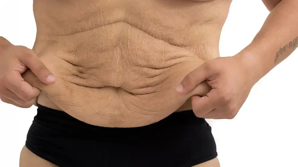 Why Does Weight Loss Medication Leave Some People With Loose or Sagging Skin Poole?